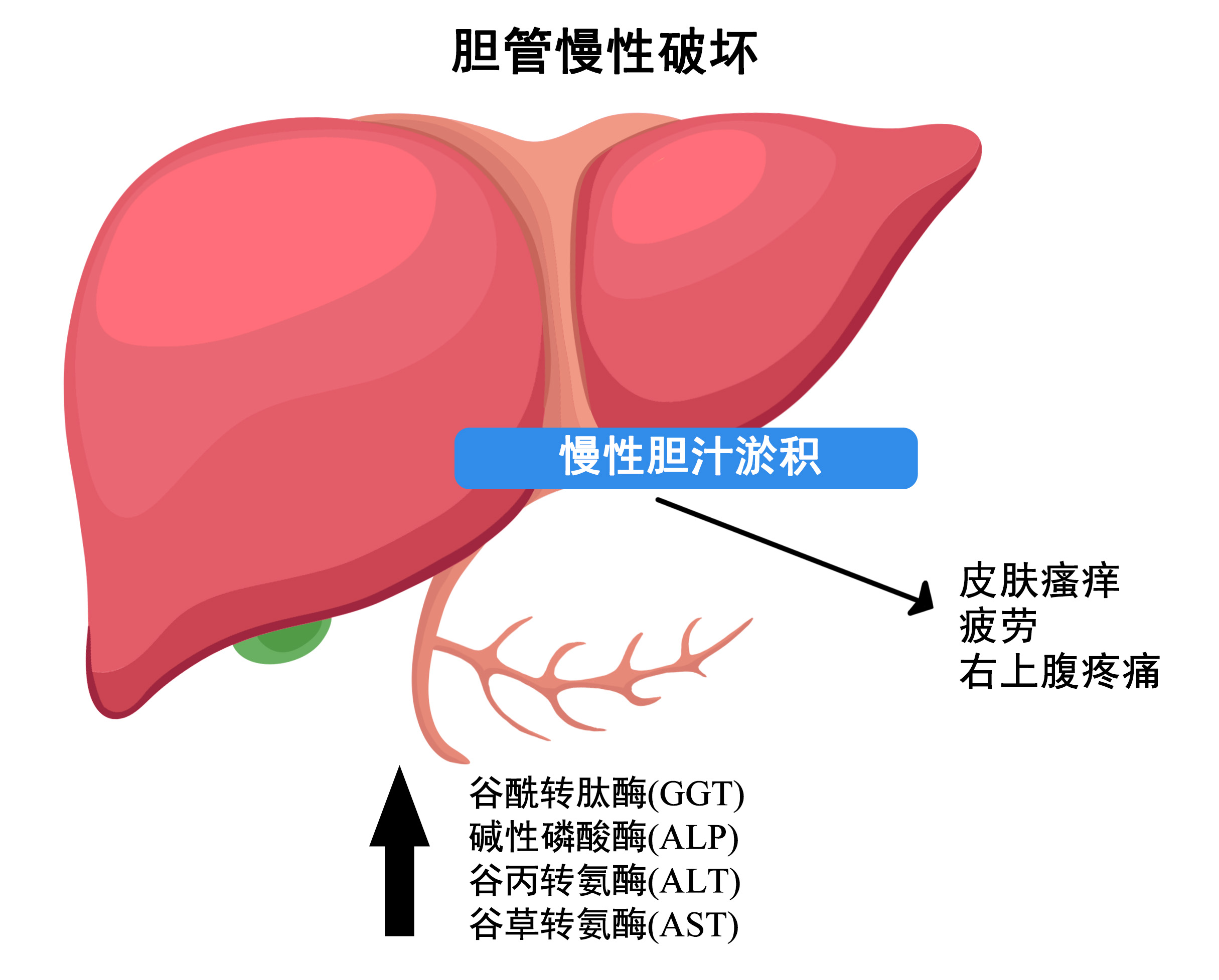 原发性胆汁性胆管炎(PBC)