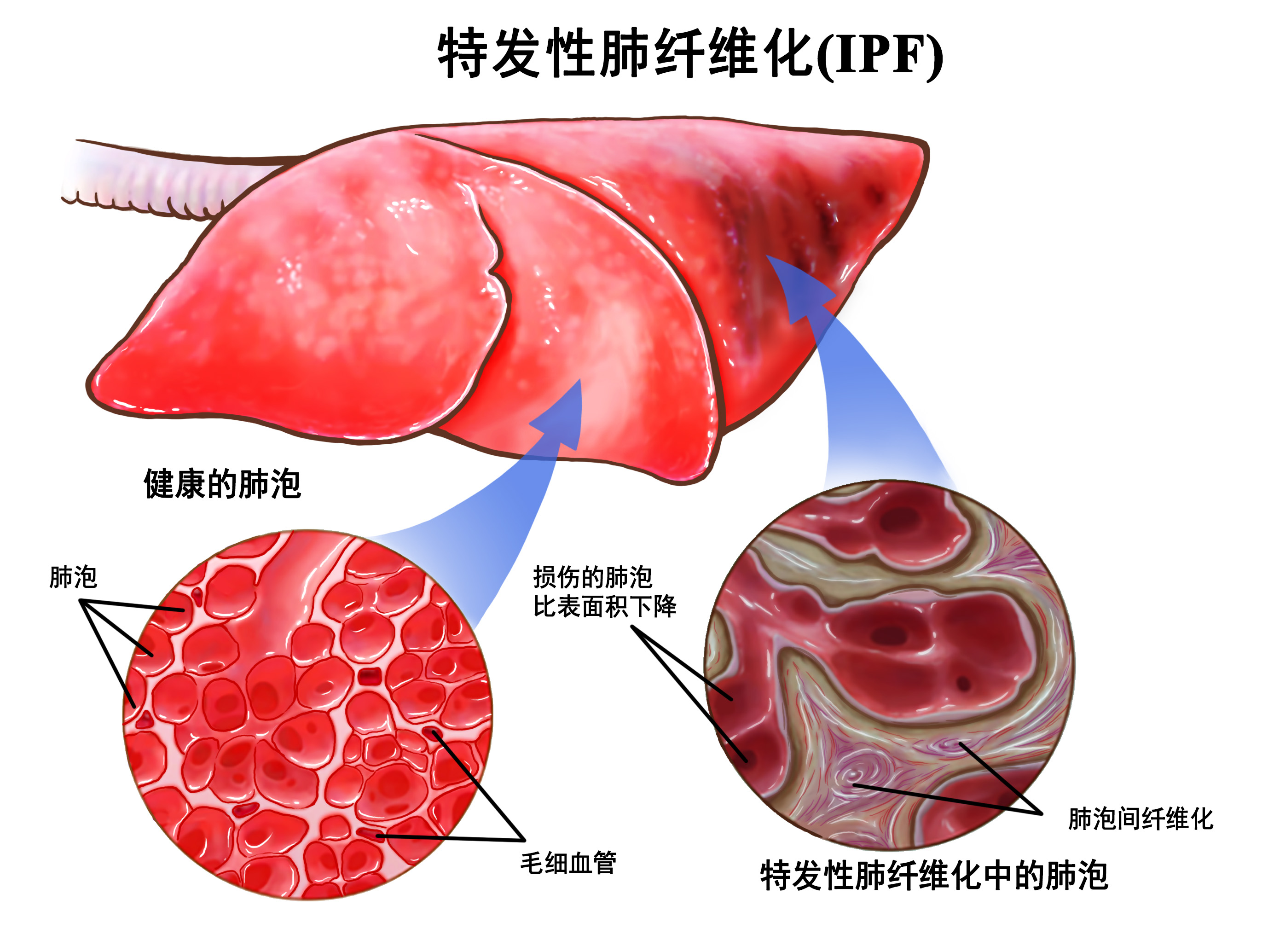 特发性肺纤维化(IPF)